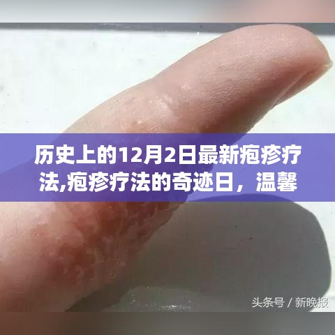 皰疹療法的奇跡日，友情與愛在歷史上的溫馨故事