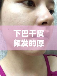 下巴干皮頻發的原因、對策及日常護理之道
