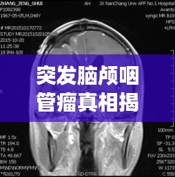 突發(fā)腦顱咽管瘤真相揭秘，探究疾病背后的秘密