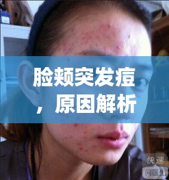 臉頰突發痘，原因解析、預防策略及應對妙招